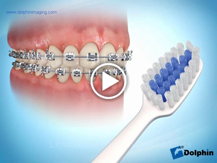 Brushing Techniques with Braces