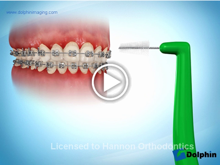 Brushing with Proxabrush - Poor Hygiene