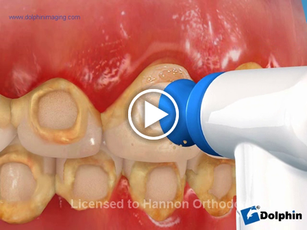 Decalcification (Orthodontics)